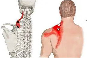 На фото показано как происходит болевой синдром из-за повышенных нагрузок на другие мышцы.